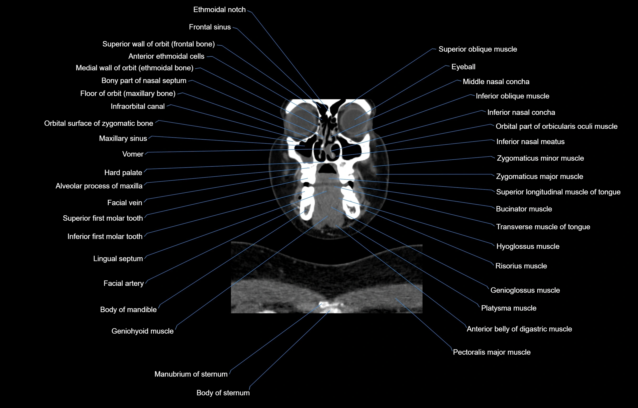 CT Neck coronal  cross sectional anatomy labelled 3D  radiology  image-00015.webp